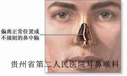 引发鼻中隔偏曲的原因有哪些