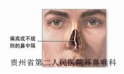 哈尔滨治疗鼻中隔偏曲的医院